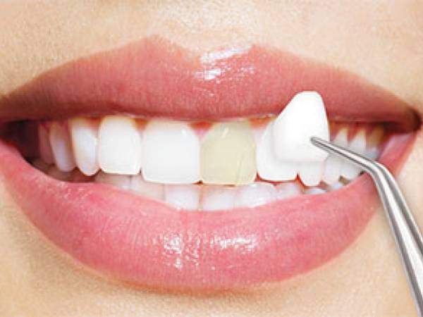 Perfect Your Smile with Porcelain Veneers in Cambridge, ON – Custom Solutions for You