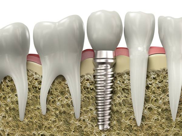 Dental Implants in Langley